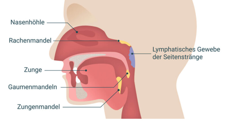 seitenstrangangina aussehen